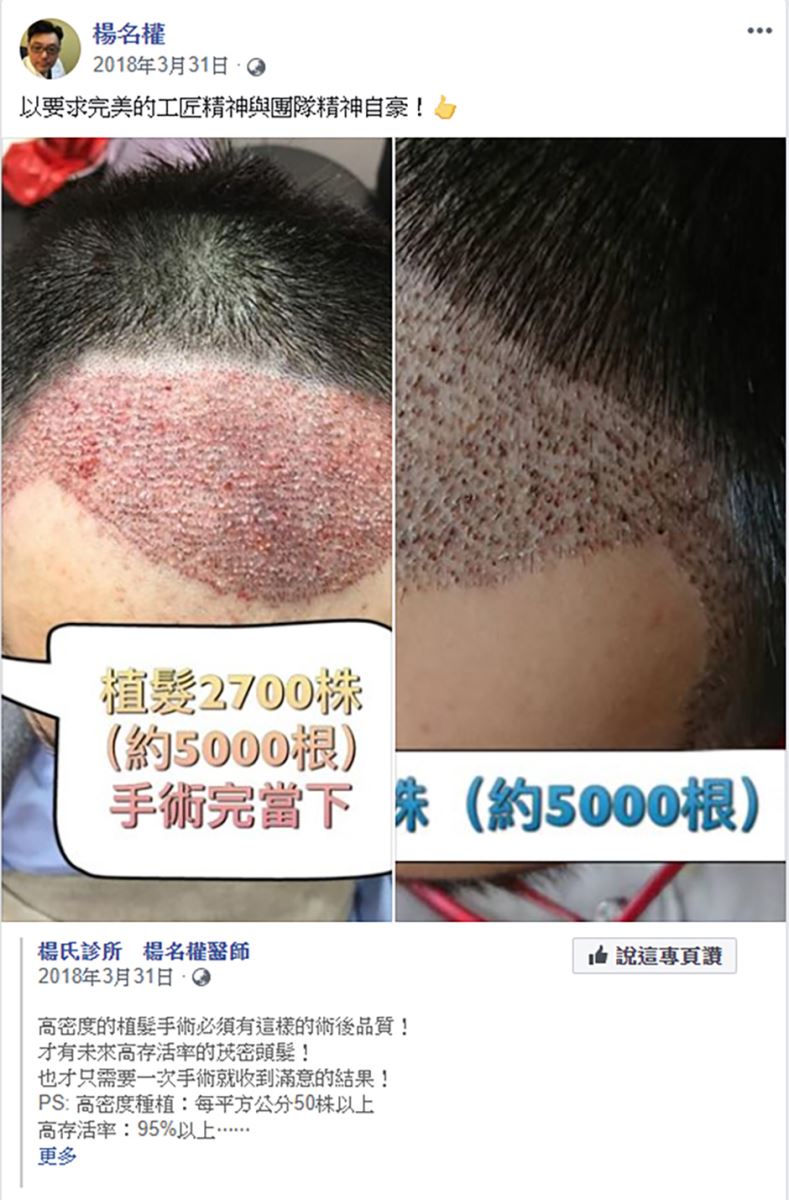 植髮,楊氏羅丹,楊名權,禿頭 生髮613